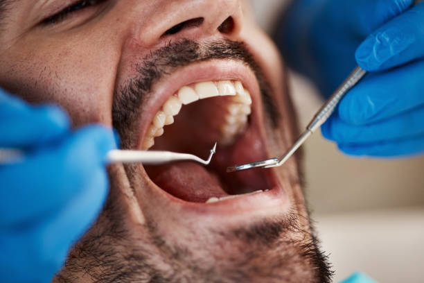 Dental Inlays and Onlays in Pleasant Grove, AL